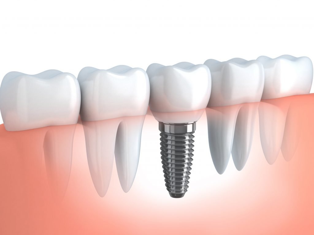 Dental implant procedure at Beacon Hill Dental Centre Burlington ON