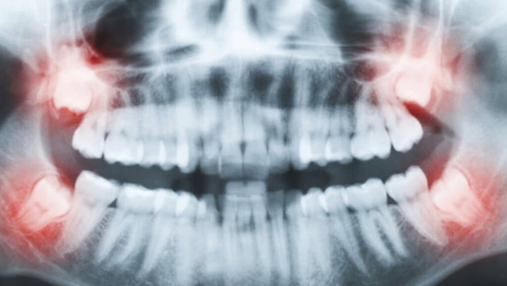 wisdom teeth