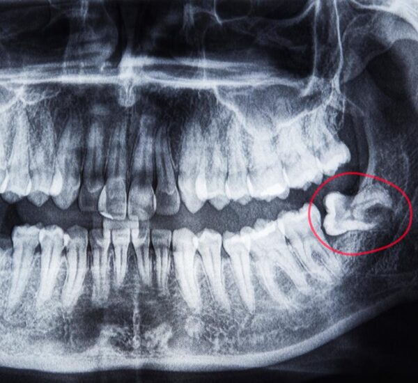 Expert Wisdom Teeth Removal in Palmer, ON Expert Wisdom Teeth Removal in Palmer, ON