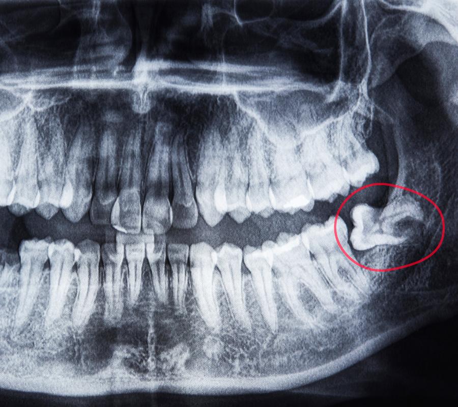 Expert Wisdom Teeth Removal in Palmer, ON