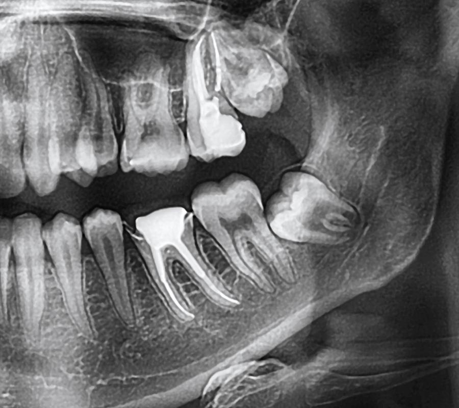 Professional Wisdom Teeth Removal in Tansley, ON