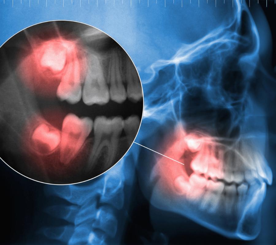 Top-rated wisdom teeth removal in Millcroft, ON