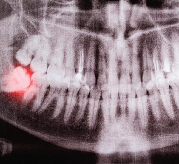 Wisdom teeth removal in Brant Hills, ON by Beacon Hill Dental Wisdom teeth removal in Brant Hills, ON by Beacon Hill Dental