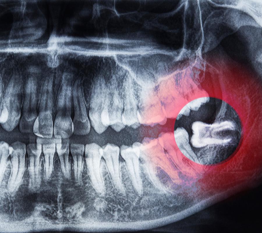 wisdom teeth removal