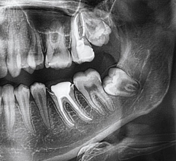Wisdom Teeth Removal in Mountain Gardens, ON – Safe and professional extractions Wisdom Teeth Removal in Mountain Gardens, ON – Safe and professional extractions