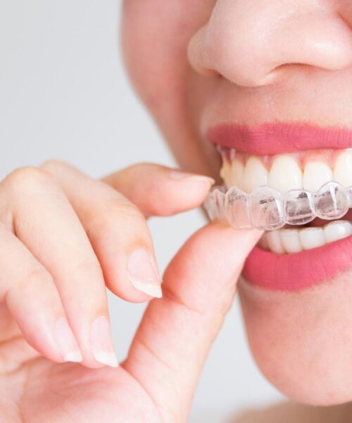 Invisalign services in Palmer ON with removable and comfortable trays
