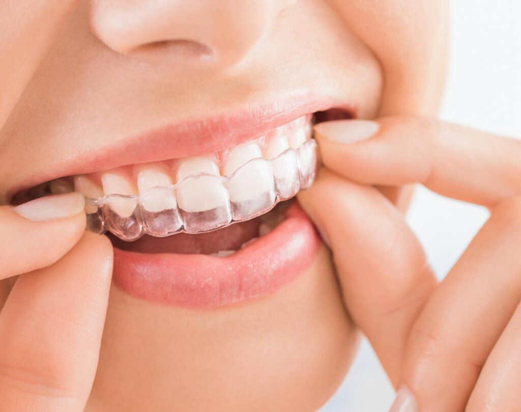 Invisalign in Mountain Gardens ON with clear trays for smile correction