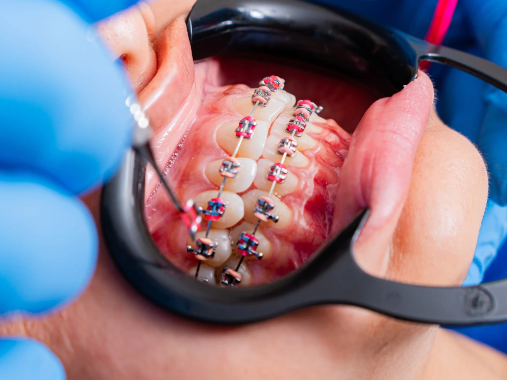 A dentist installing braces to a client
