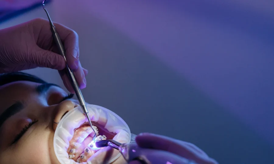 A dentist using UV to fix a brace bracket on a teeth