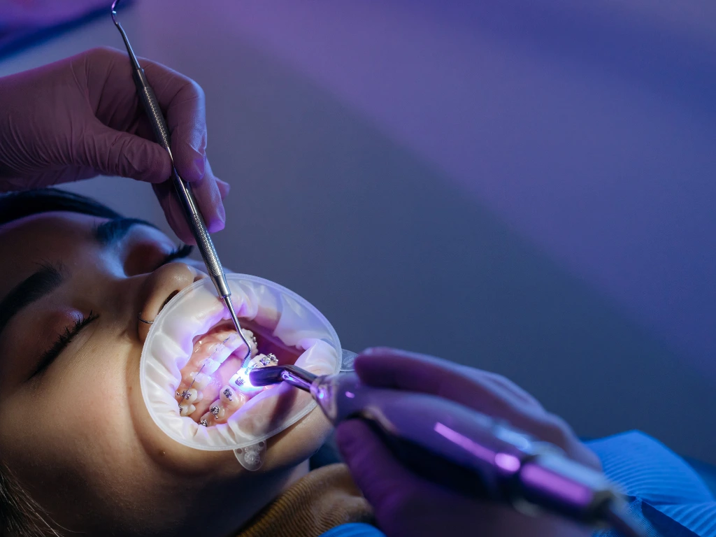 A dentist using UV to fix a brace bracket on a teeth
